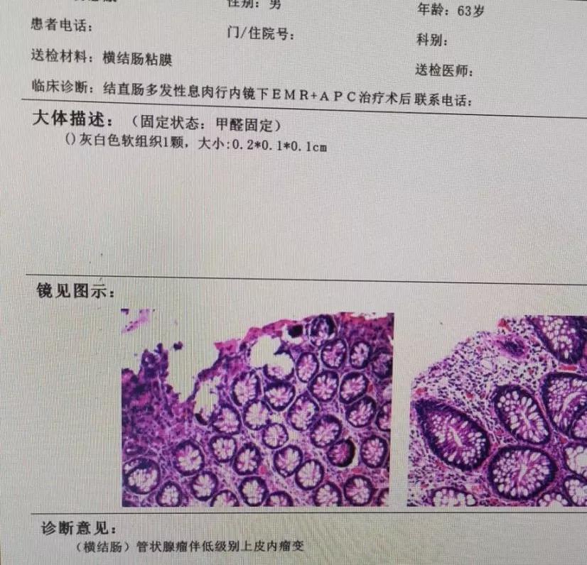 最后老杨的肠镜结果是结直肠多发性息肉,横结肠,乙状结肠分别可见多