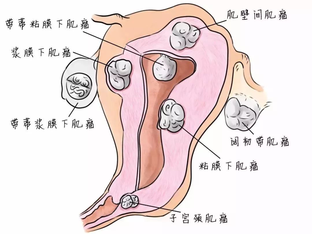 按照生长位置的不同,体检报告里肌壁间肌瘤,浆膜下肌瘤,子宫肌肌瘤等