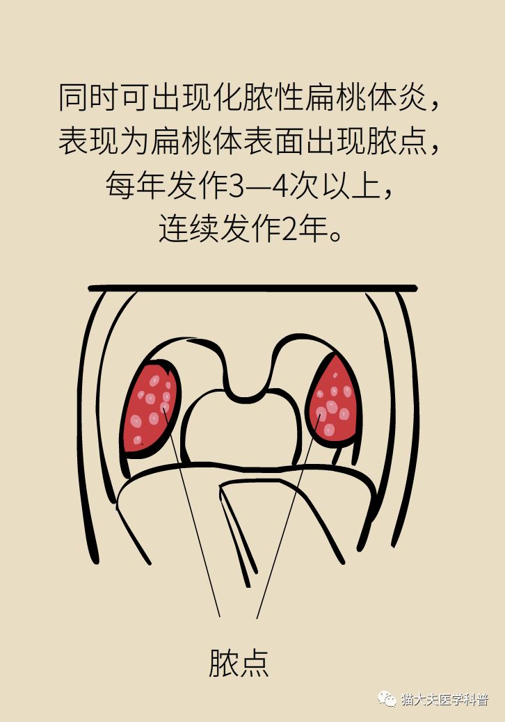 扁桃体反复发炎割不割