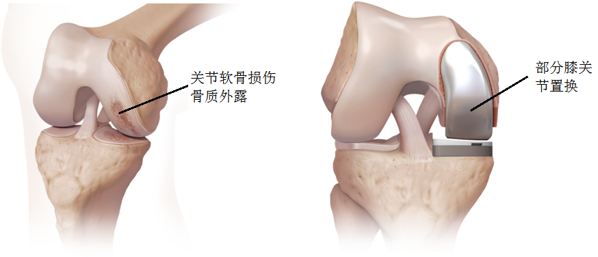 人工膝关节置换术常见问题解答