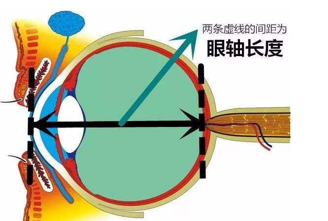 近视眼镜是什么原理近视眼镜原理示意图3