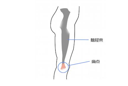 学名髂胫束综合症,之前我们也介绍过,多发于膝关节弯曲30至40度,痛点