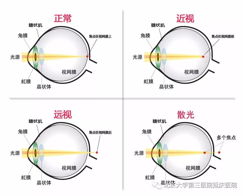 远视储备就是孩子对应年龄的屈光状态,参考如下表