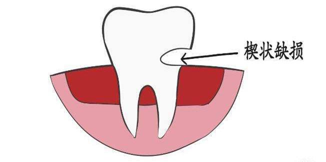牙根部有一道槽怎么办