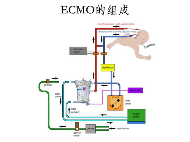 体外膜肺ecmo支持技术