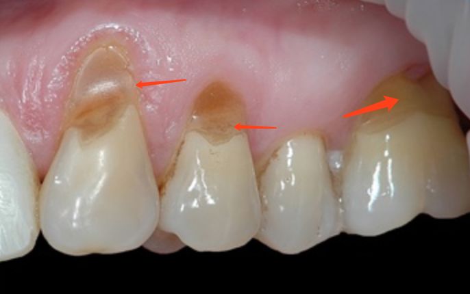 楔缺楔状缺损和刷牙方式,咬合等都有关系,楔缺容易导致牙齿敏感,严重