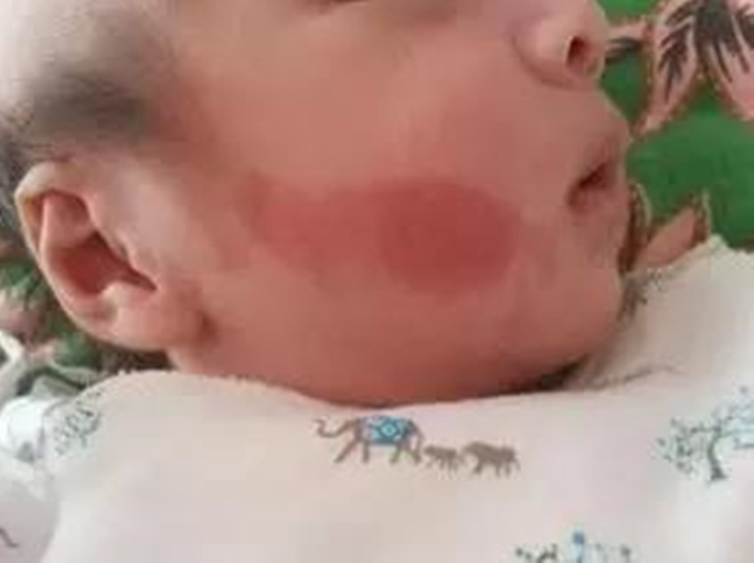                     听说胎记是赐予宝宝最好的礼物？错！这种情况下的胎记要尽早治疗