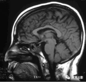 人口腔肉瘤_口腔卡波西肉瘤图片(2)