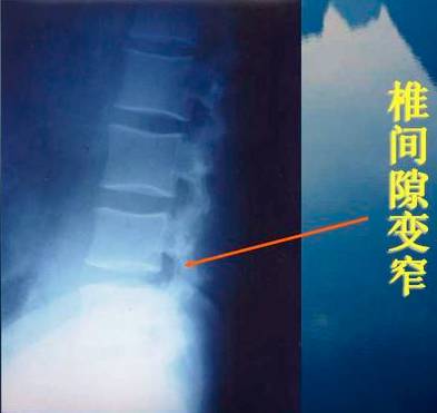多节段间盘突出mri:间盘脱出mri:间盘前后方突出,椎间隙狭窄椎间