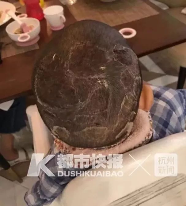 水烧伤吃什么好 e7f527a243894d35a9c00197dcb51d95.jpeg