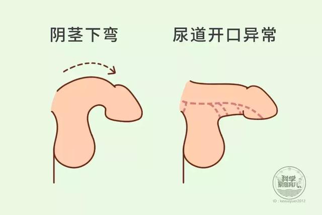 包皮割不割娃的5道私处选择题一道都错不起67