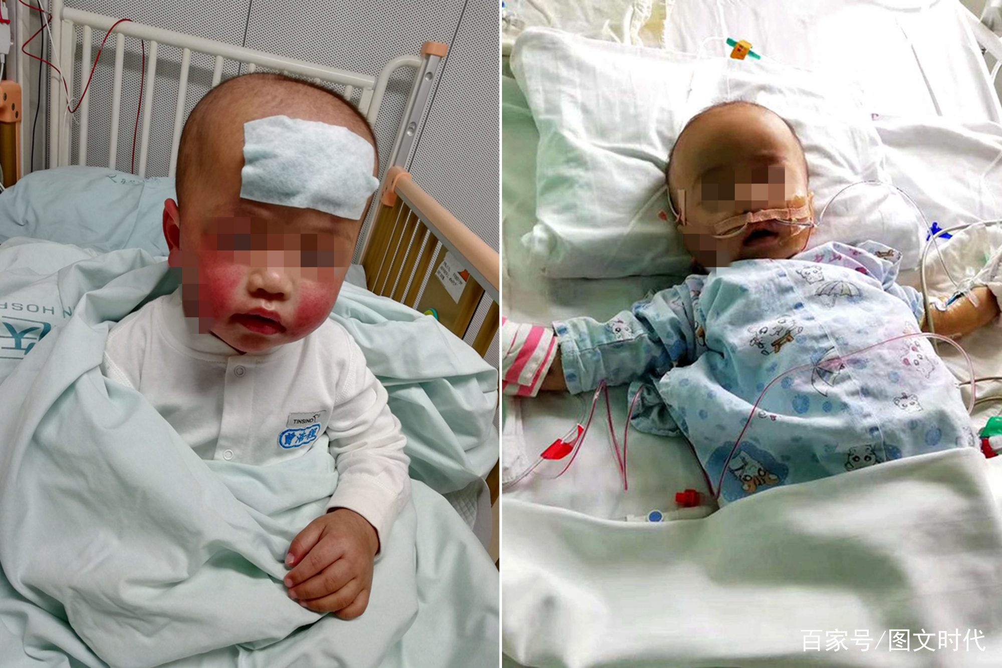                     男婴脸上长了一个红疙瘩，后被切除半张脸，10天后又确诊癌症