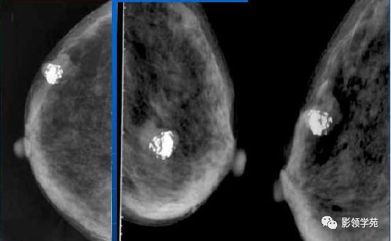 乳腺钙化的鉴别诊断与分级