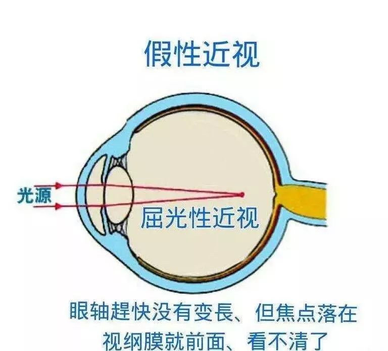 眼睛过度疲劳,当心假性近视变真性近视