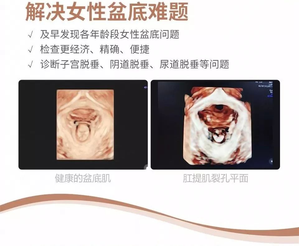 美国ge系列盆底超声检查