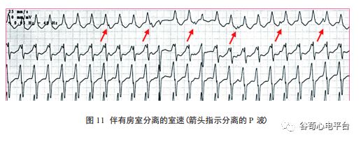 图12显示宽qrs波心动过速时,当存在室上性夺获和室性融合波等心电图