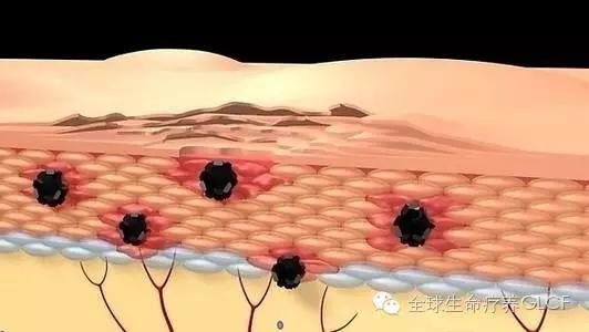 皮肤细胞营养疗法_黑色素