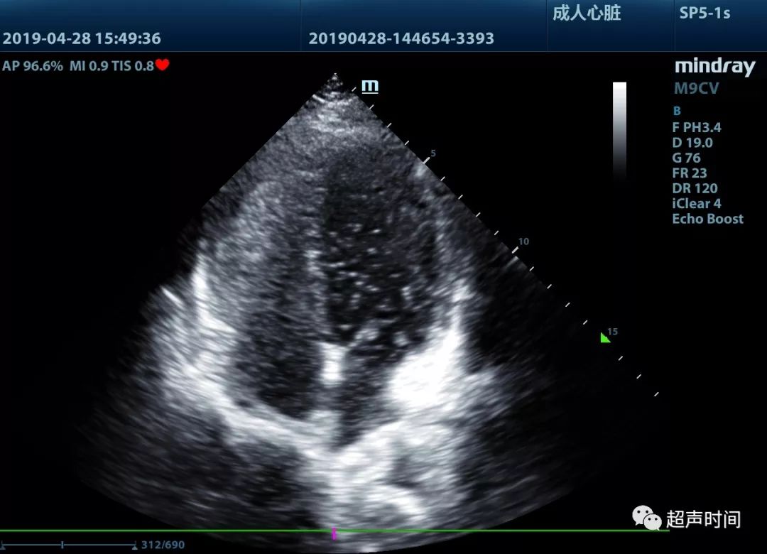 右心声学造影——2016超声心动图检查指南解读[j].