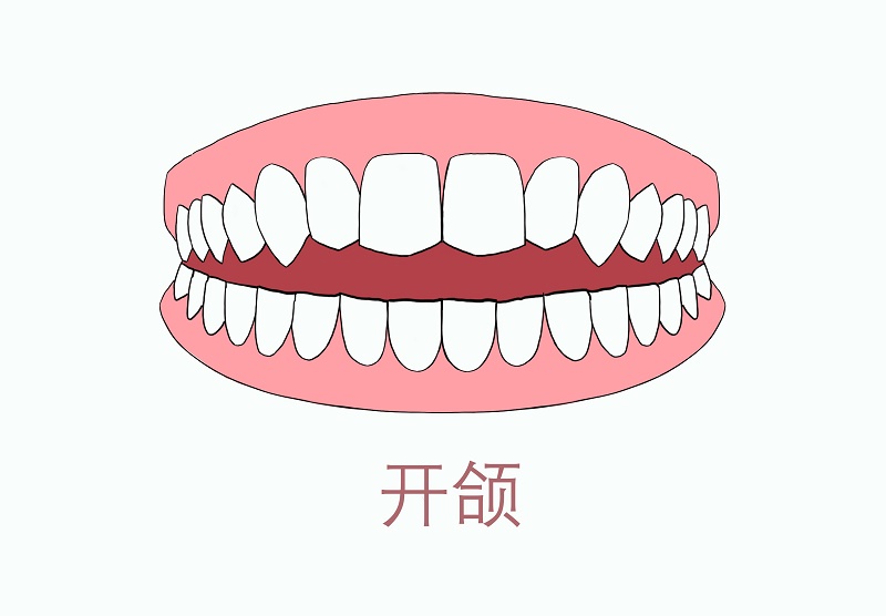 由于前牙不能完美的咬合,就会影响到前牙的咀嚼功能,因此常伴有胃肠道