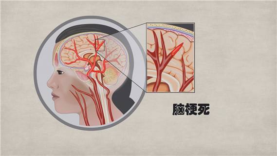 视力下降为何与脑梗相关?需要注意枕叶梗死#中风#脑梗死