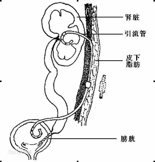 太吓人男子膀胱3块大石头足有半斤多重