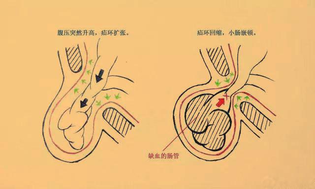 腹直肌分离最严重的,会引起腹白线疝,肠疝,但这是少数,碰到这种情况