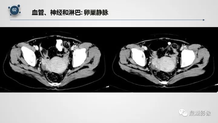 精品推荐 | 子宫附件影像解剖