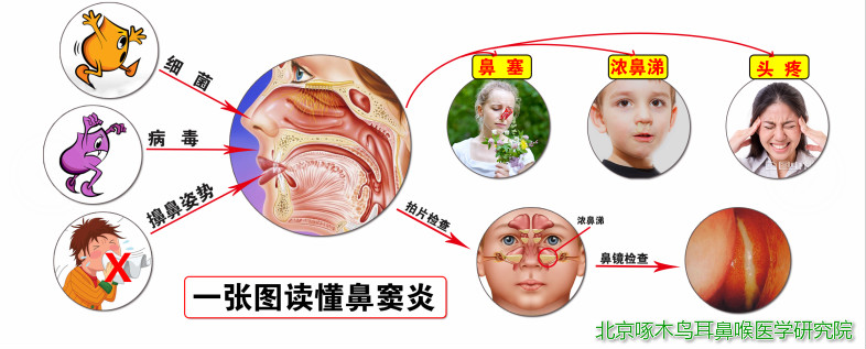 鼻窦炎的治疗_鼻腔