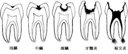 明明是去补牙,怎么医生倒把牙洞越磨越大了?