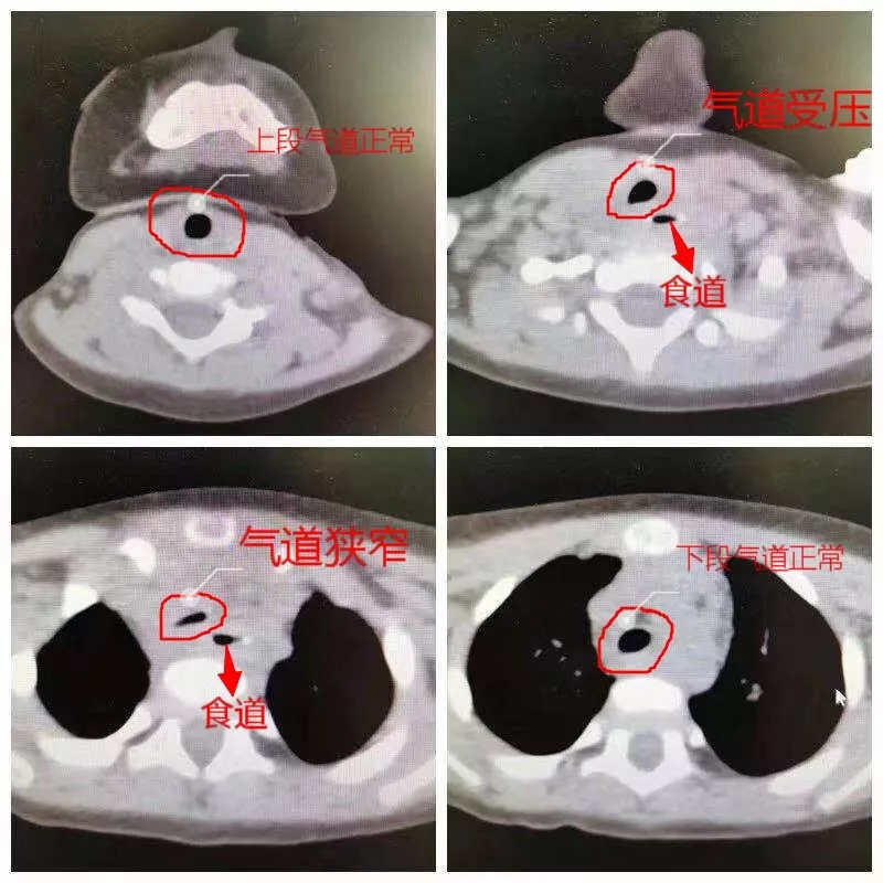 因孩子出现气道狭窄,且喉炎初期不宜行电子支气管镜术,易导致喉头