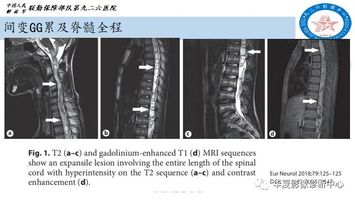 有了它脊髓肿瘤病变的诊断你会轻松一些。