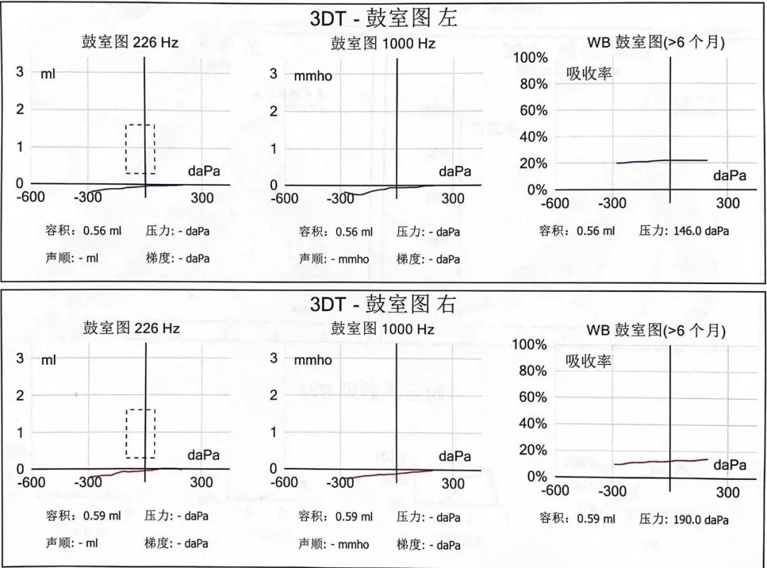 听损儿童由于得了分泌性中耳炎,听力会下降.