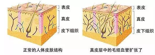 脸上有红脸蛋怎么办