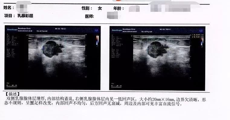 重大阳性典型病例-肺癌叶女士,38岁,于2019年4月在美年大健康北京公司