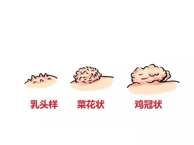 包皮尖锐湿疣早期症状有哪些,关于男人们开不了口的痛