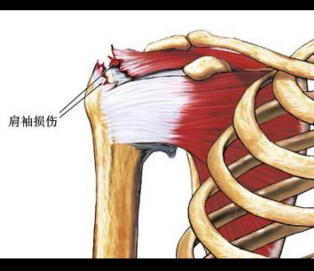 肩膀扭着了怎么办