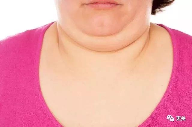 脂肪堆积 脂肪堆积导致脖子短粗很好理解,发胖一般都是全身胖,肩膀