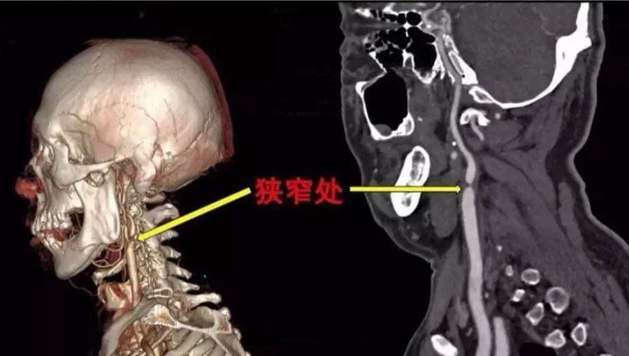 小科室大作为省中医院溧阳分院介入科完成一例颈动脉狭窄合并血管溃疡