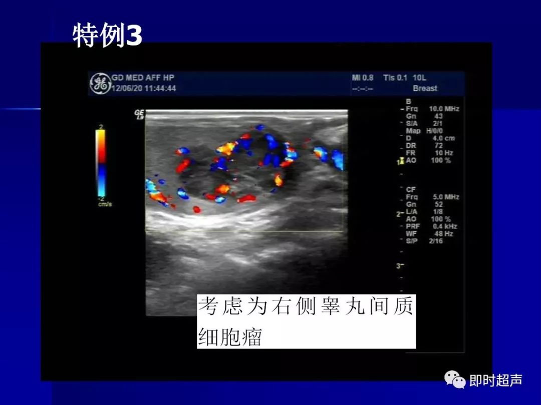 [睾丸肿瘤][睾丸和附睾炎][隐睾]