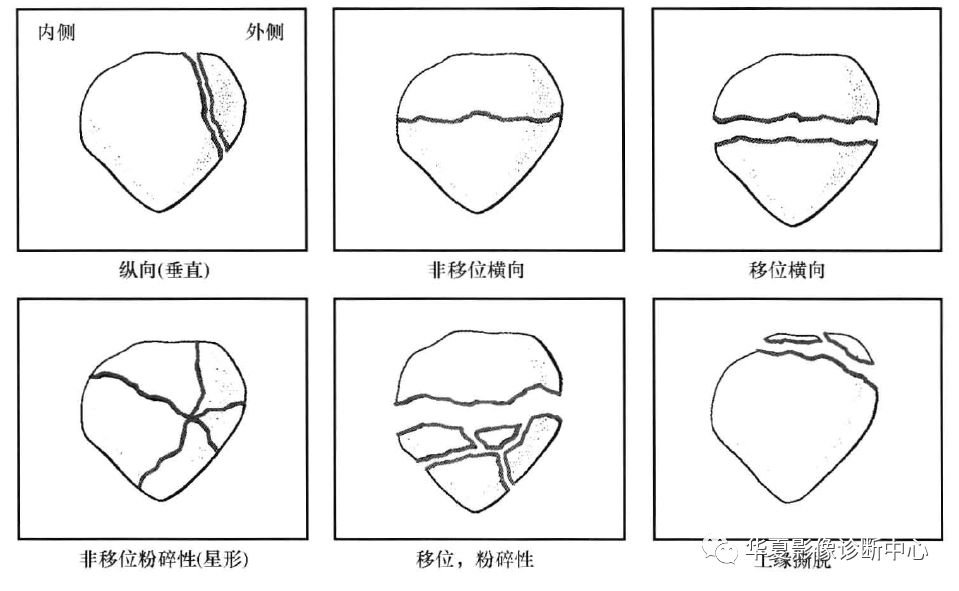 影像基础髌骨骨折分型