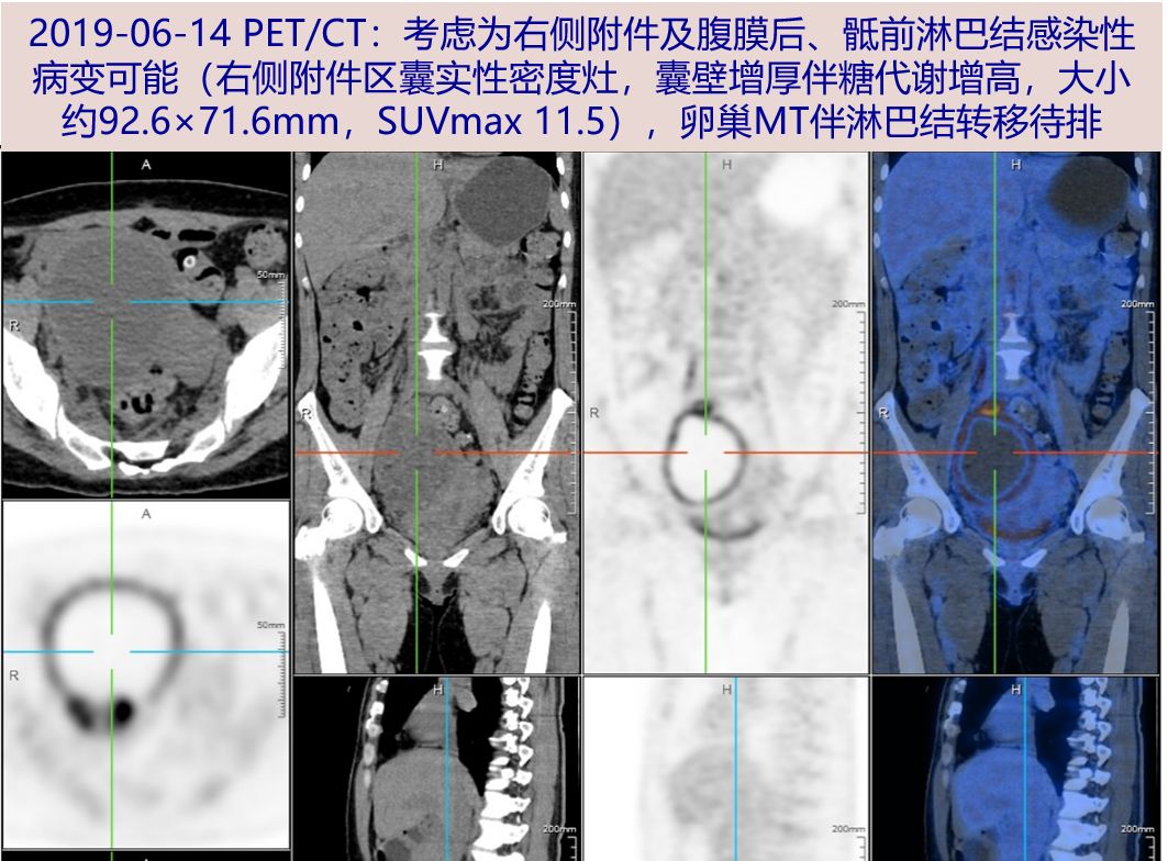 探案中年女性发热两周附件囊肿会是元凶