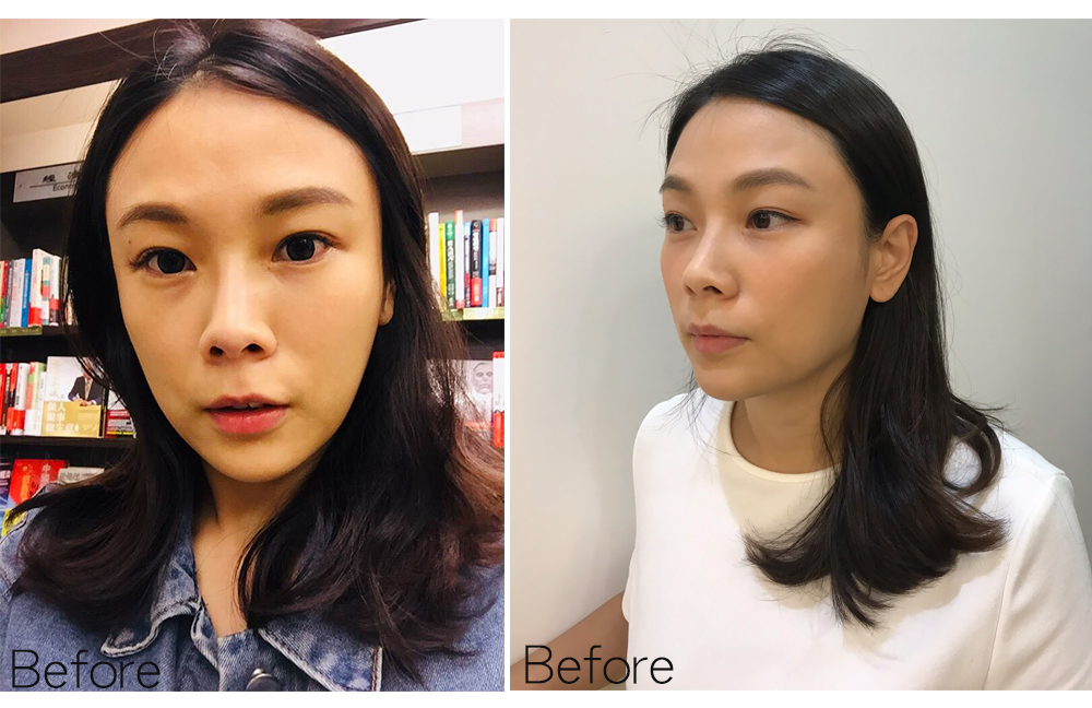 新型女神动态玻尿酸让你变的自然青春又亮丽 云顶国际网站