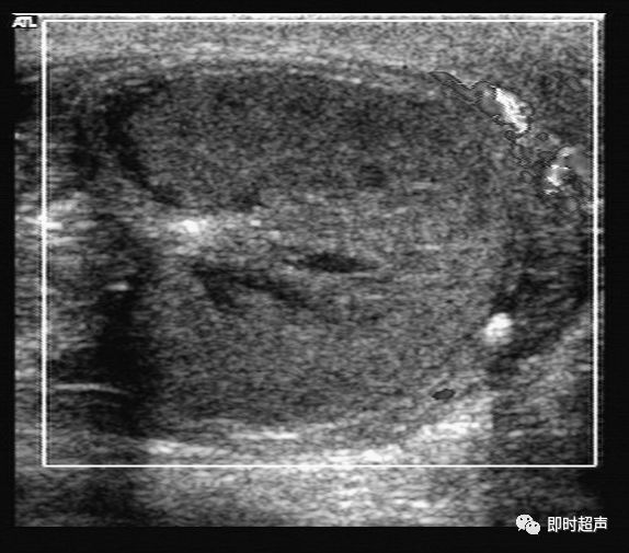 阴囊及其内容物的超声诊断