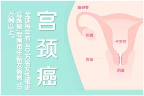 据统计, 全球每年死于宫颈癌的女性高达20万人,中国女性占10%的比例.