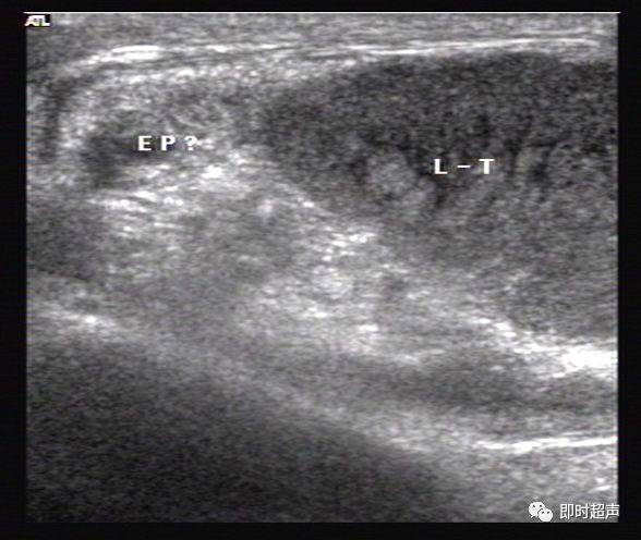 阴囊及其内容物的超声诊断