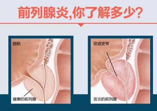 膀胱造瘘什么原理_膀胱造瘘图片(3)