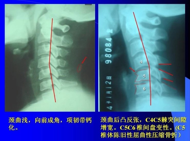 颈椎,胸椎,腰椎阅片技巧
