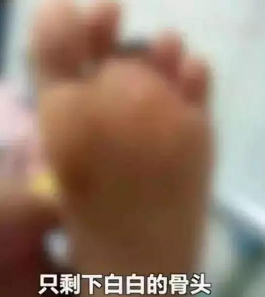                     惊！宝宝玩滑梯折断脚，只因妈妈做了这个动作，很多父母都没意识到这很危险