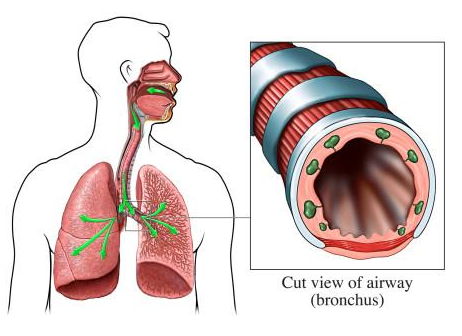 疾病分析:支气管炎