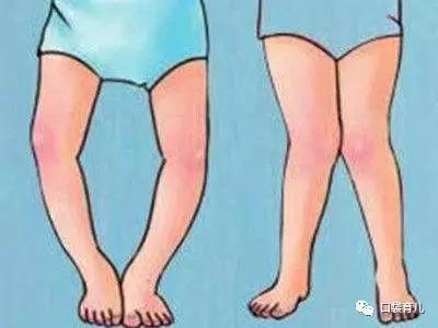                     原创            关于学步、O型腿、X型腿……看了这篇就不纠结了！